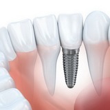 Зубные импланты известных и надежных производителей в Асти