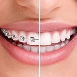 Исправление прикуса врачем ортодонтом стоматологии